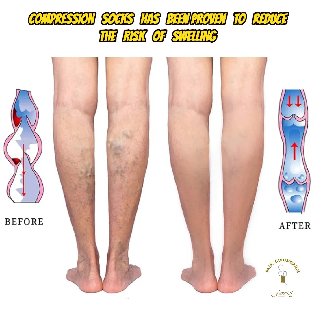 Performance 20-30 mmHg Medical Compression Socks for Women and Men Knee High Open Toe Stockings Varicose Vein Swollen legs